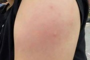 接种疫苗后红肿是正常反应吗？如何缓解和处理