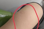打狂犬疫苗后反应解析：注射部位红肿与全身不适