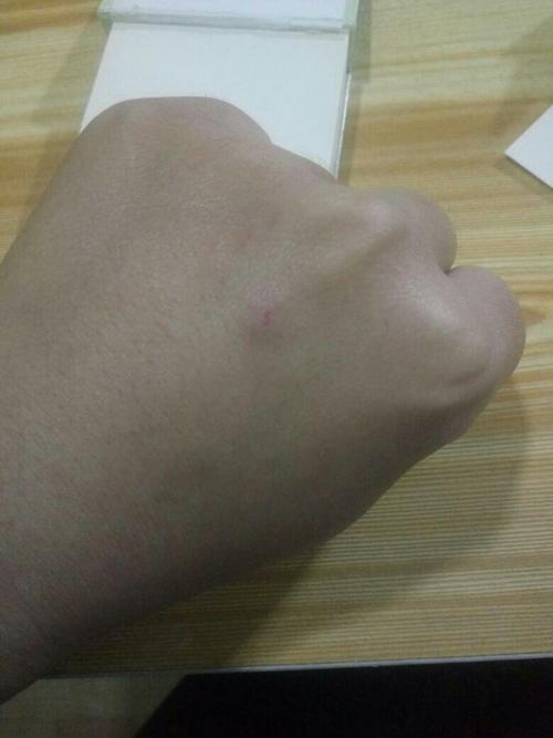 牙印成为温馨的印记(轻微咬伤留下的痕迹诉说宠物的温情与淘气)