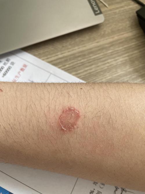 猫癣症状