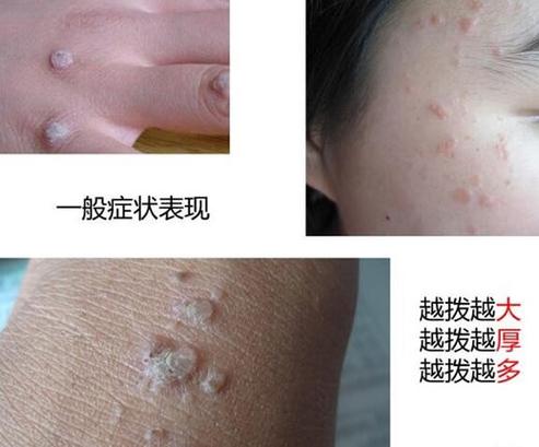 什么是细小病毒什么症状的,什么是细小病毒症状