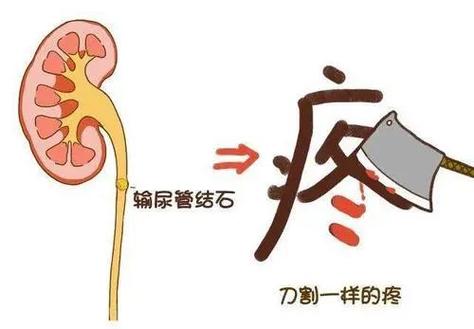 尿钙化是什么意思啊,什么叫尿钙