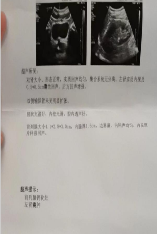 尿钙化是什么意思啊,什么叫尿钙