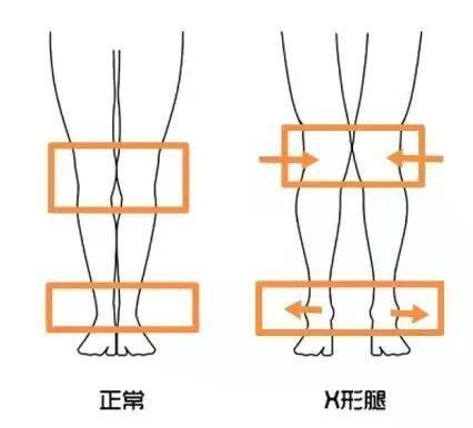 亚短腿和中腿怎么判断折叠图,亚短腿示意图