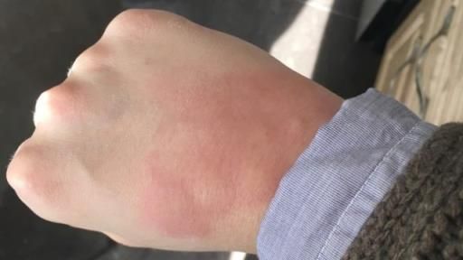 虱子咬后的症状图片,虱子咬人后的图片
