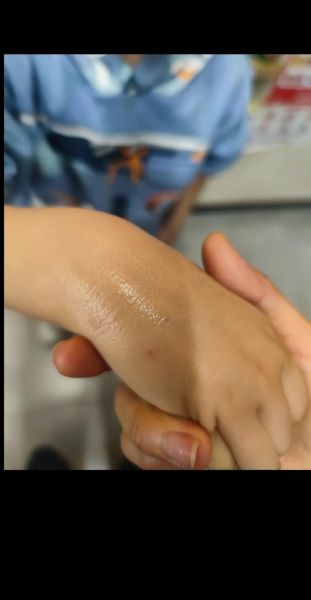 被猫抓伤10日观察法,小猫几个月打疫苗多少钱
