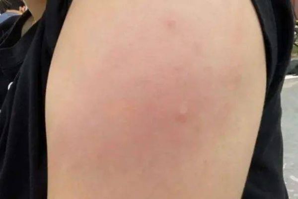 接种疫苗后红肿是正常反应吗?如何缓解和处理