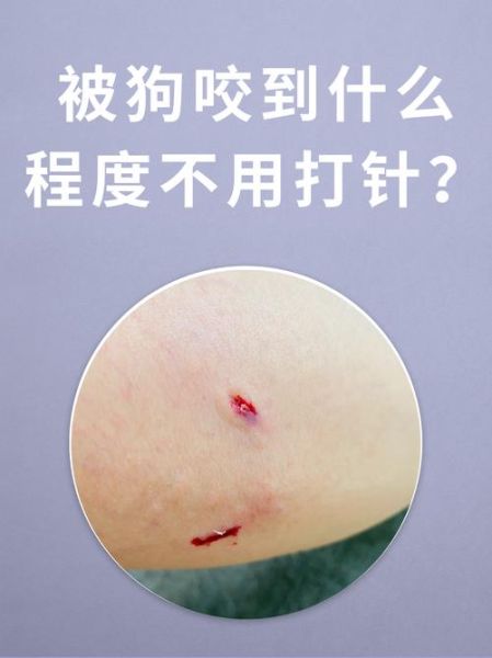 打了狂犬疫苗的狗咬人仍有风险,必须这样处理